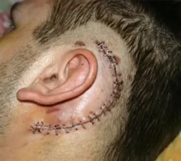 درمان انواع تومورهای گوش 0913125