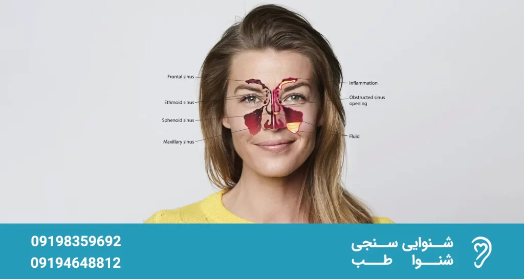 3456465 بررسی عوارض و تاثیر سینوزیت بر گوش عوارض و تاثیر سینوزیت