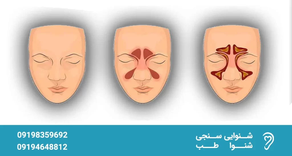 7646465 بررسی عوارض و تاثیر سینوزیت بر گوش عوارض سینوزیت و تاثیر آن بر گوش