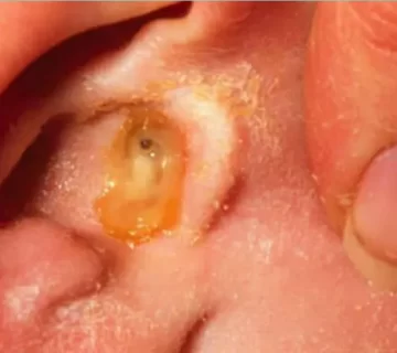 علل، علائم و درمان عفونت گوش 091316