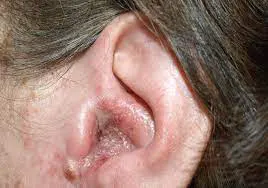 0913302 واکس گوش چیست؟ آیا تولید ترشحات در گوش خطرناک است؟ ترشحات گوش چیست؟