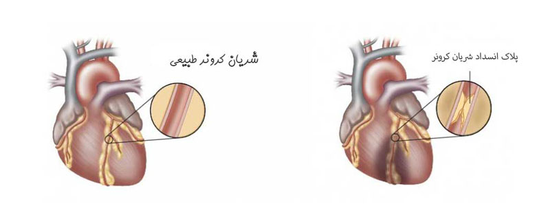 0913320 گرفتگی رگ قلب و ارتباط آن با بروز سرگیجه گرفتگی رگ قلب