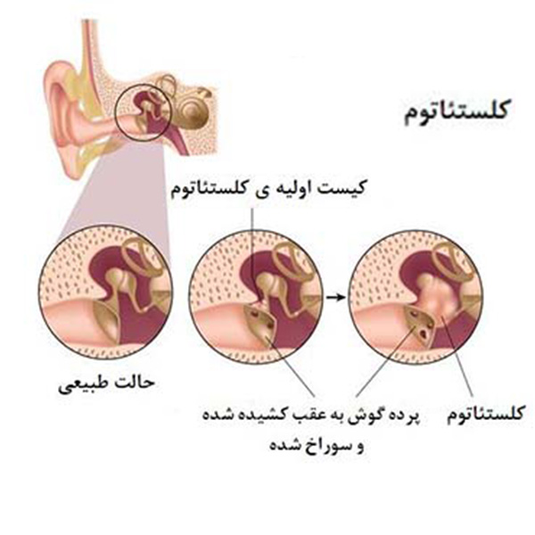 کیست گوش میانی