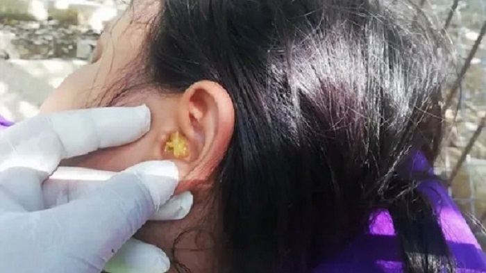 0913348 کیست گوش میانی یا کلستاتوم و درمان آن کیست گوش میانی چیست