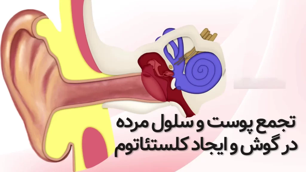 0913350 کیست گوش میانی یا کلستاتوم و درمان آن کیست گوش میانی