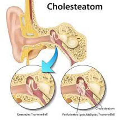 0913351 کیست گوش میانی یا کلستاتوم و درمان آن کیست گوش میانی