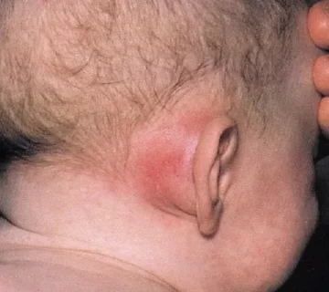 ماستوئیدیت یا عفونت استخوان گوش علائم و درمان