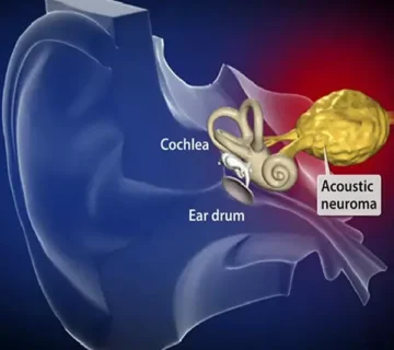 تشخیص و درمان تومور عصب شنوایی