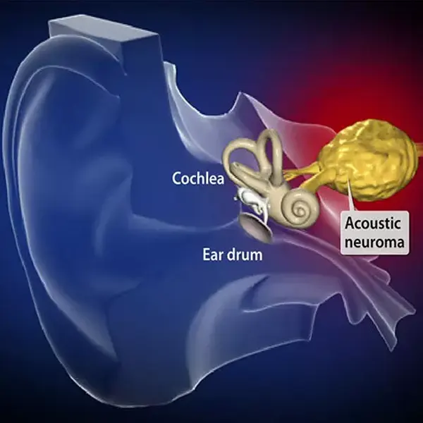 تشخیص و درمان تومور عصب شنوایی