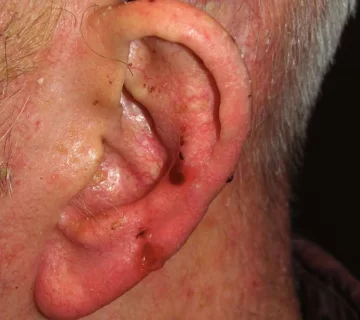 علائم و دلائل سرطان گوش بدخیم