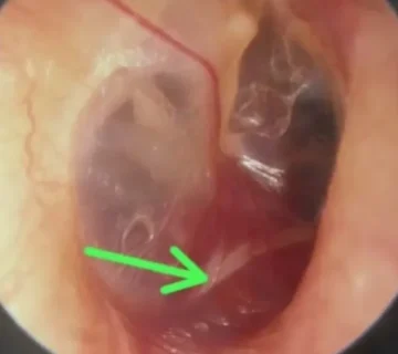 شناخت تومور گلوموس علائم پیشگیری درمان