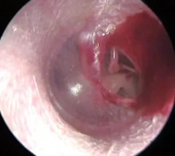 با عمل پرده گوش و مراقبت های بعد از عمل آشنا شویم