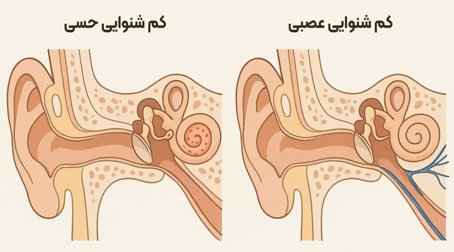 کم شنوایی عصبی و حسی درمان کم شنوایی عصبی در سال ۲۰۲۵: روشهای نوین و امیدهای تازه برای بازسازی شنوایی تفاوت کم شنوایی عصبی و کم شنوایی حسی